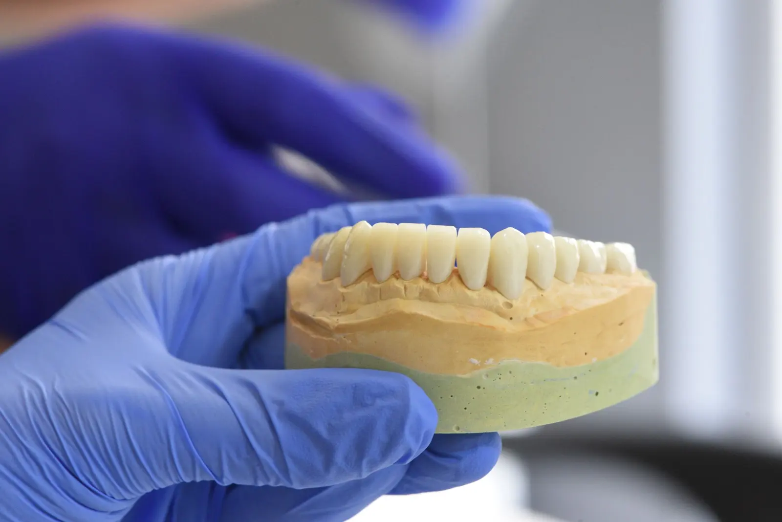 Modello in gesso di un'arcata con i denti, tenuto da mani con i guanti